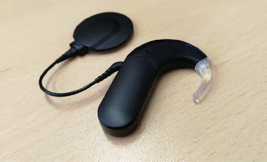 人工内耳の利点は何ですか?